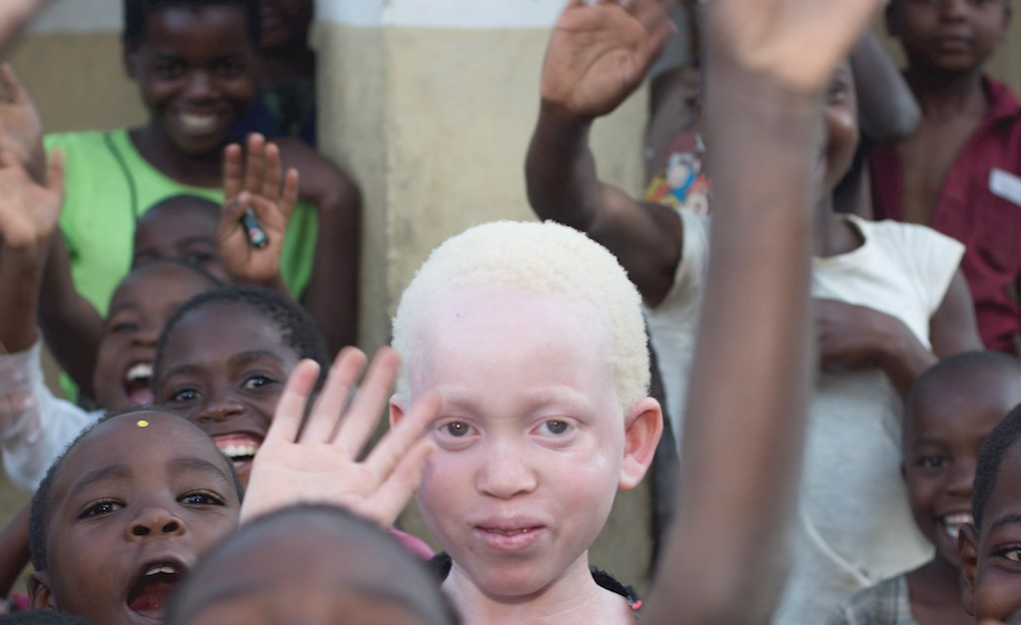 Superstition, Albino